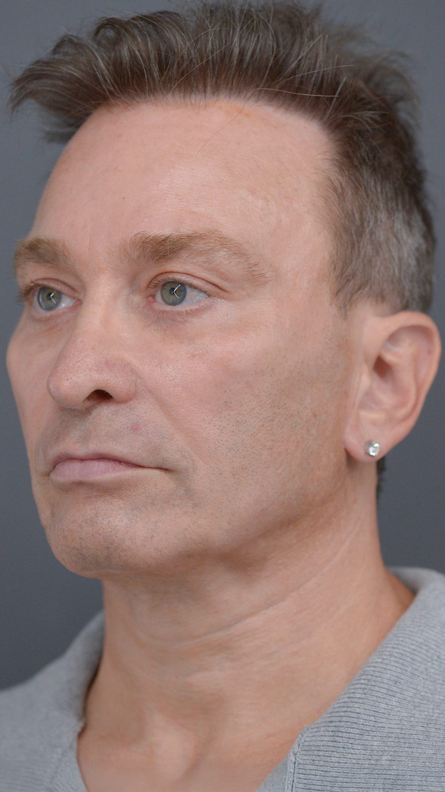 Ponytail Facelift before and after, case 23, view 5 (after)