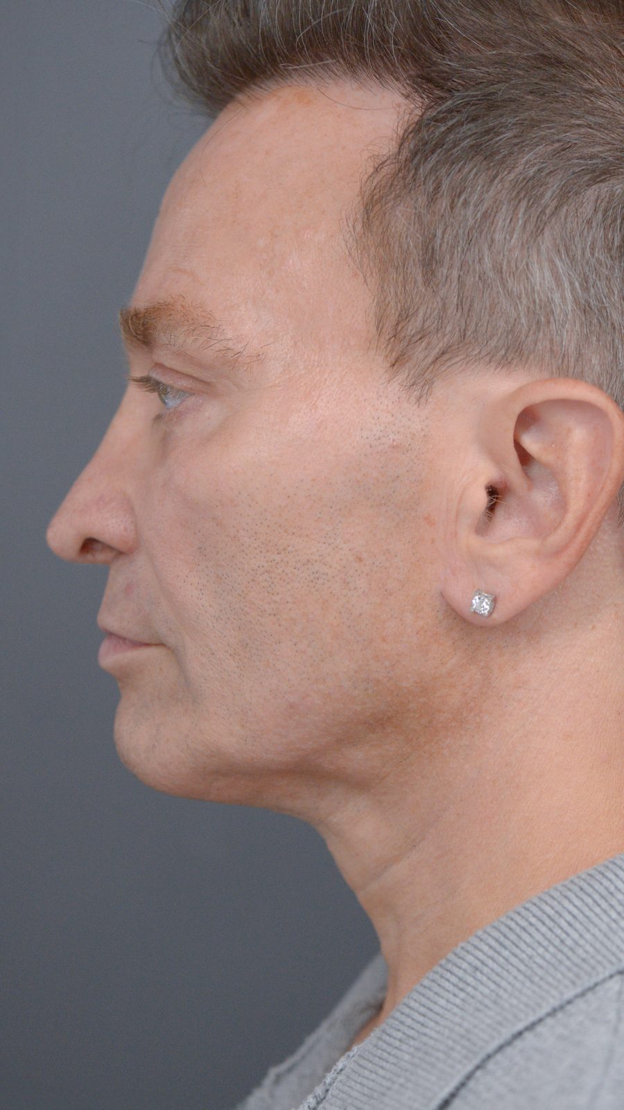 Ponytail Facelift before and after, case 23, view 6 (after)
