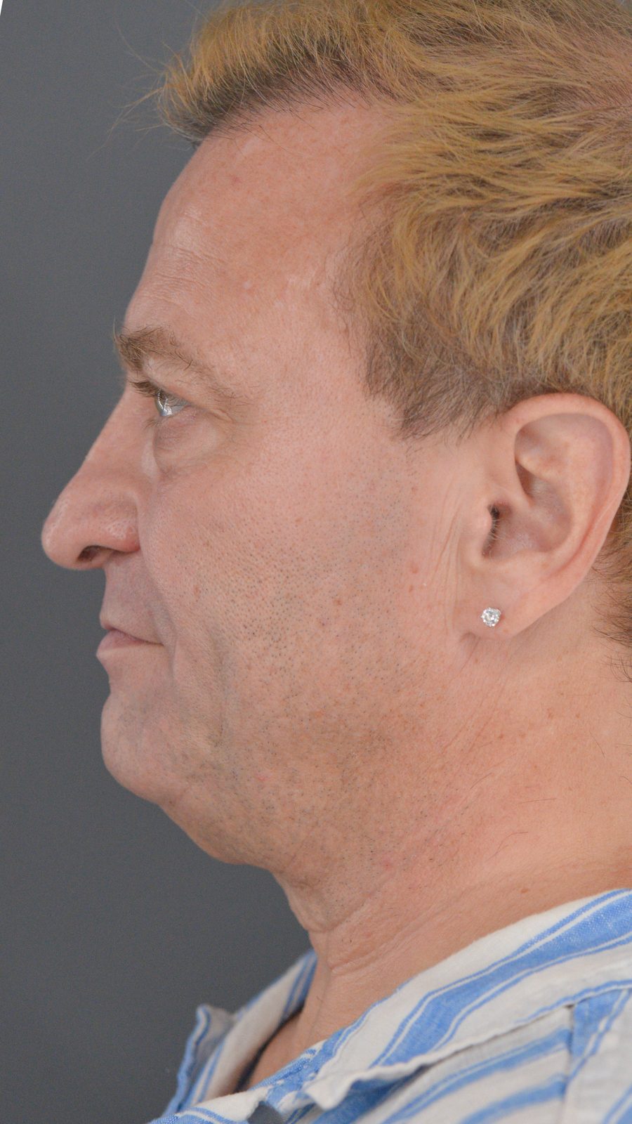 Ponytail Facelift before and after, case 23, view 6 (before)