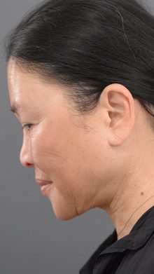 Ponytail Facelift before and after, case 24 (after)