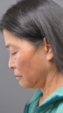 Ponytail Facelift before and after, case 24 (before)