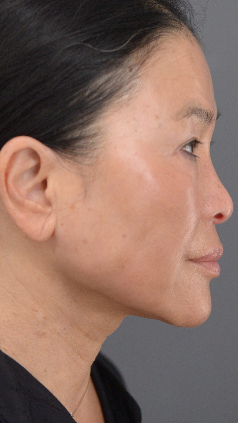 Ponytail Facelift before and after, case 24, view 3 (after)