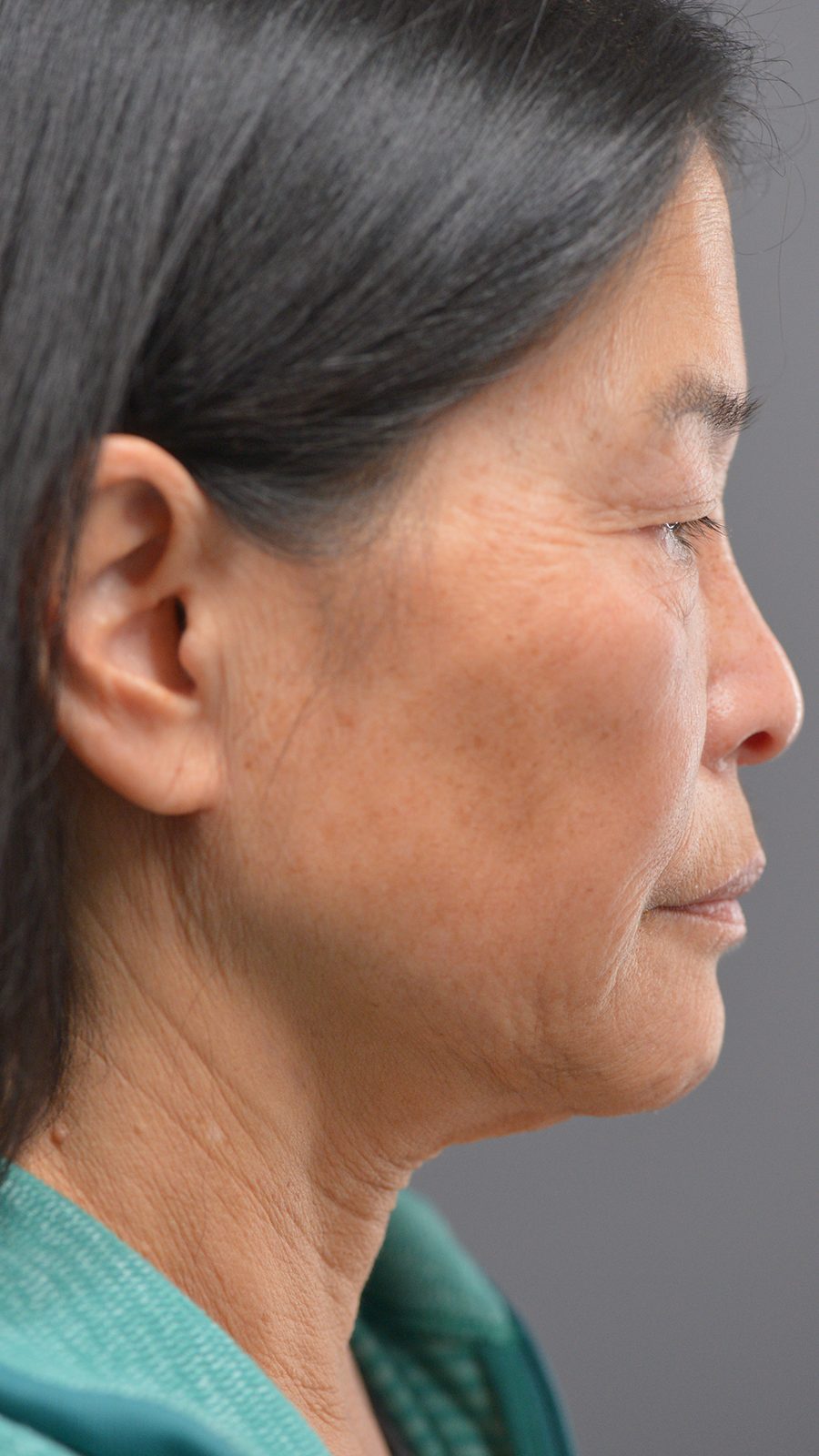 Ponytail Facelift before and after, case 24, view 3 (before)