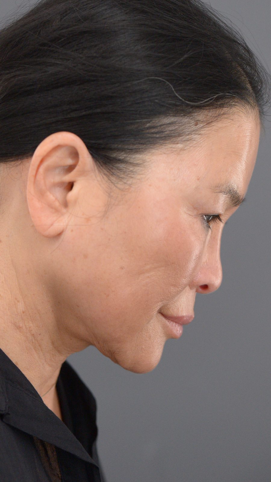 Ponytail Facelift before and after, case 24, view 4 (after)