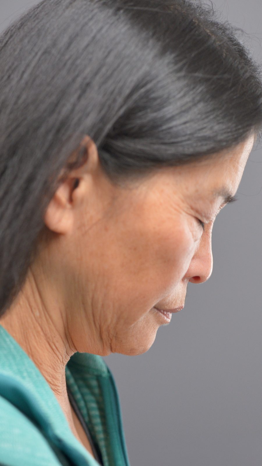 Ponytail Facelift before and after, case 24, view 4 (before)