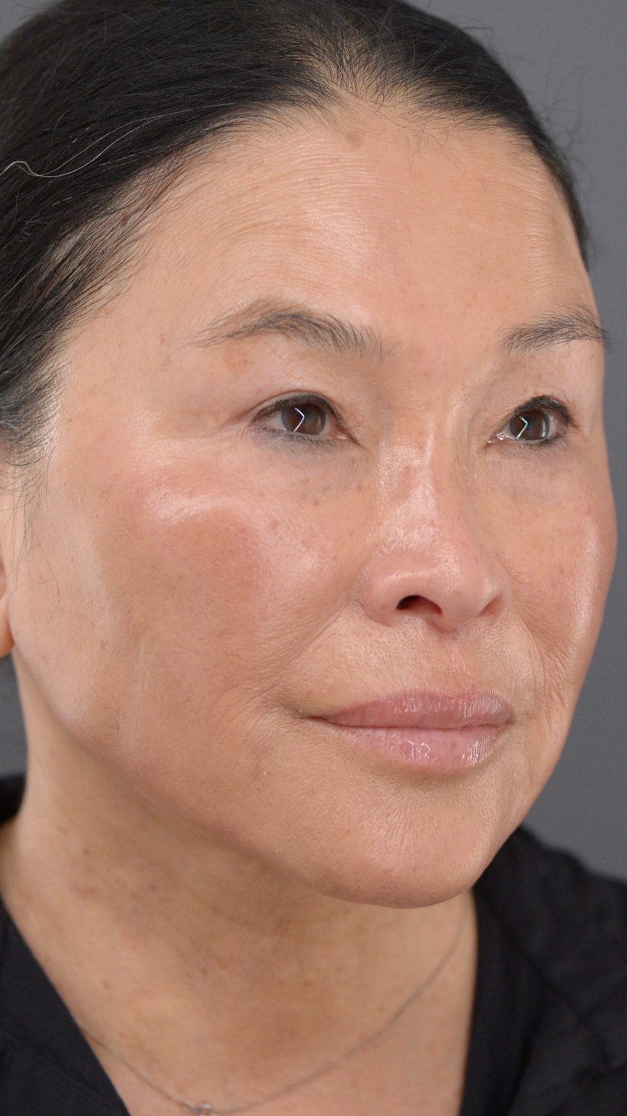Ponytail Facelift before and after, case 24, view 5 (after)