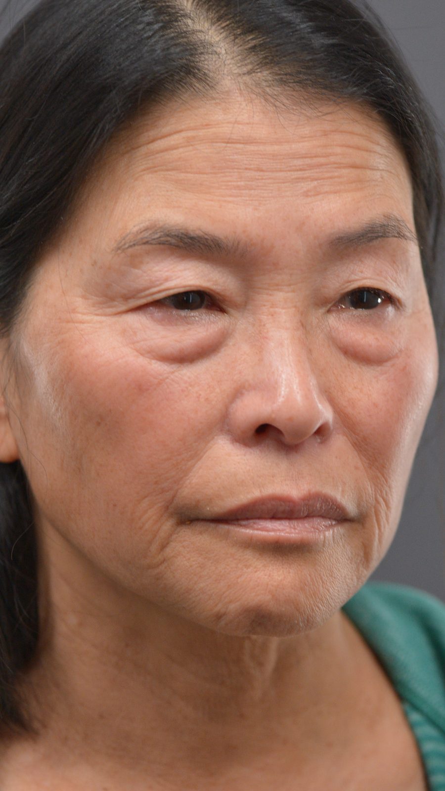 Ponytail Facelift before and after, case 24, view 5 (before)