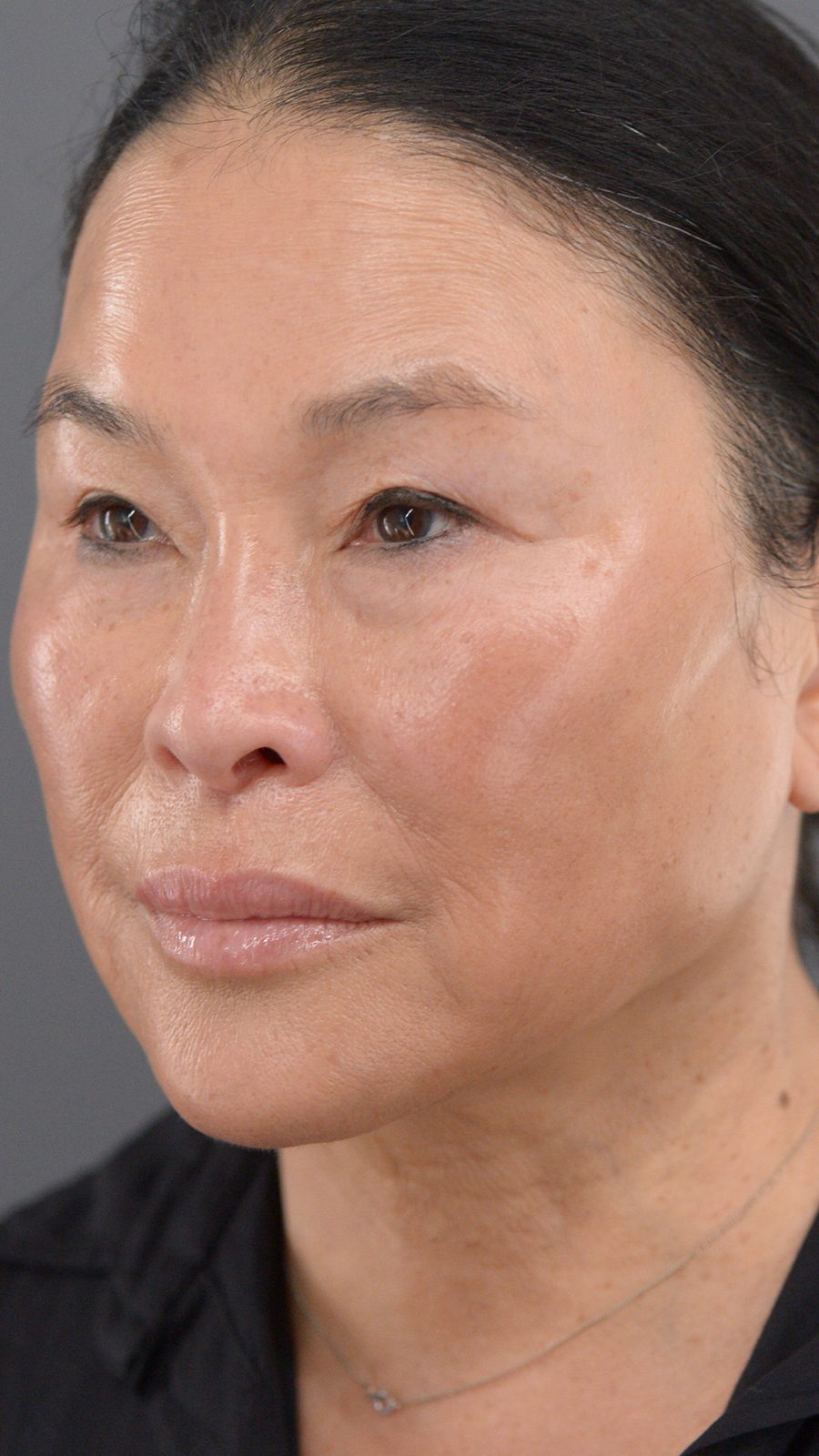 Ponytail Facelift before and after, case 24, view 6 (after)