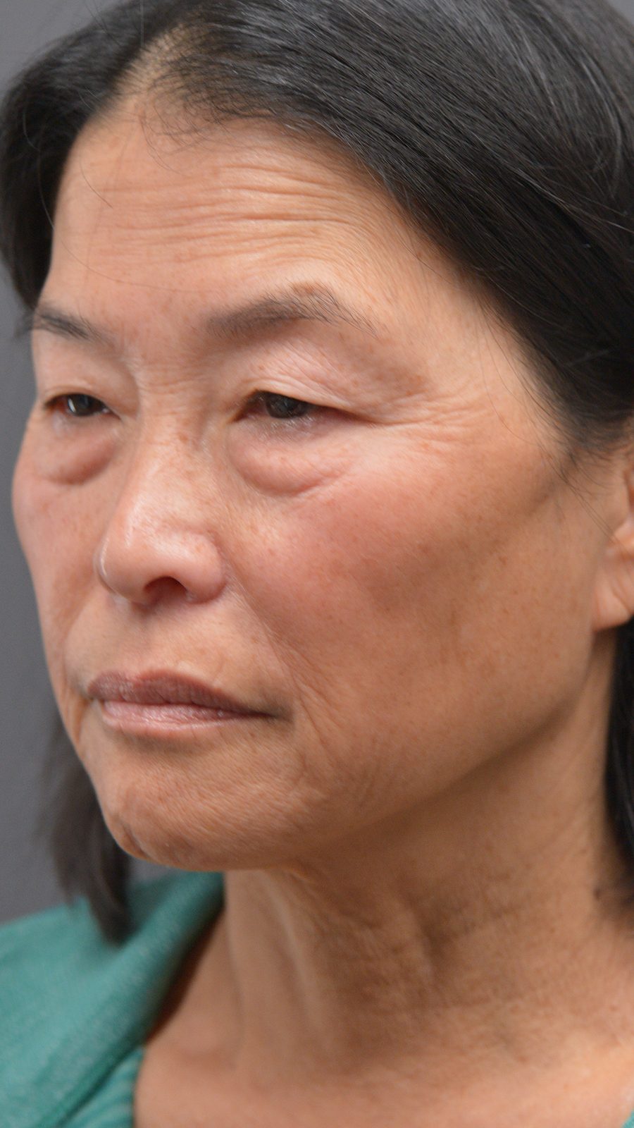 Ponytail Facelift before and after, case 24, view 6 (before)