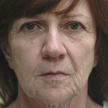 Ponytail Facelift before and after, case 25 (before)