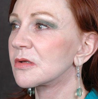 Ponytail Facelift before and after, case 25, view 3 (after)