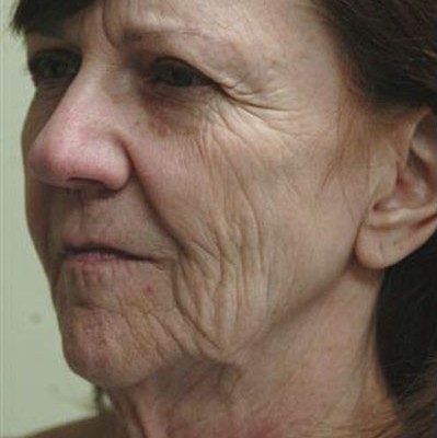 Ponytail Facelift before and after, case 25, view 3 (before)