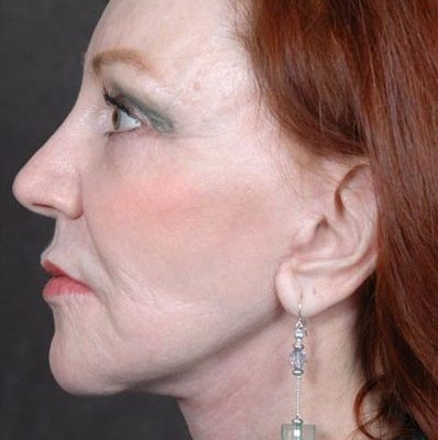 Ponytail Facelift before and after, case 25, view 4 (after)