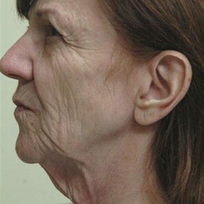 Ponytail Facelift before and after, case 25, view 4 (before)