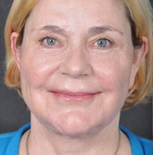 Ponytail Facelift before and after, case 26 (after)