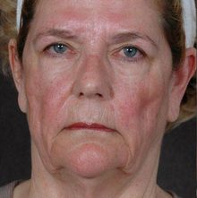 Ponytail Facelift before and after, case 26 (before)