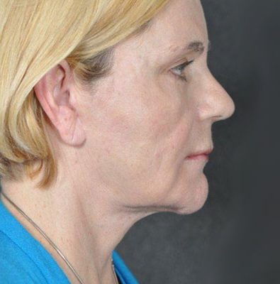 Ponytail Facelift before and after, case 26, view 3 (after)