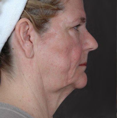 Ponytail Facelift before and after, case 26, view 3 (before)