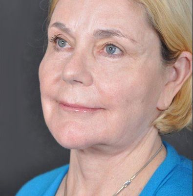 Ponytail Facelift before and after, case 26, view 4 (after)