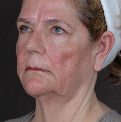 Ponytail Facelift before and after, case 26, view 4 (before)