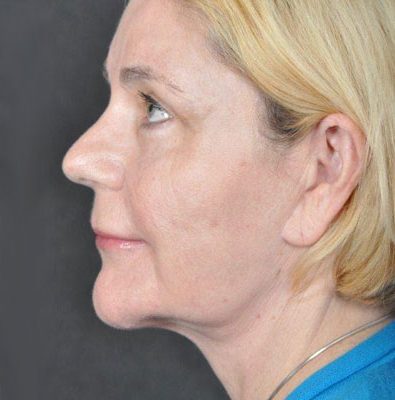 Ponytail Facelift before and after, case 26, view 5 (after)