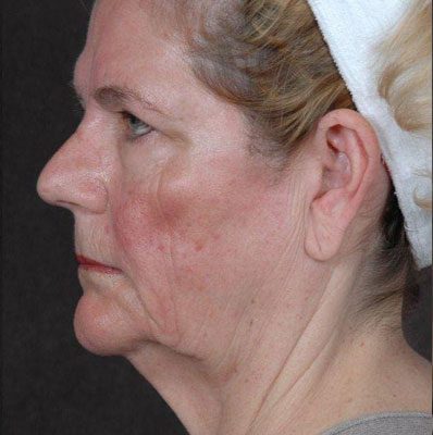 Ponytail Facelift before and after, case 26, view 5 (before)