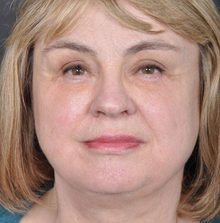 Ponytail Facelift before and after, case 27 (after)