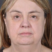 Ponytail Facelift before and after, case 27 (before)