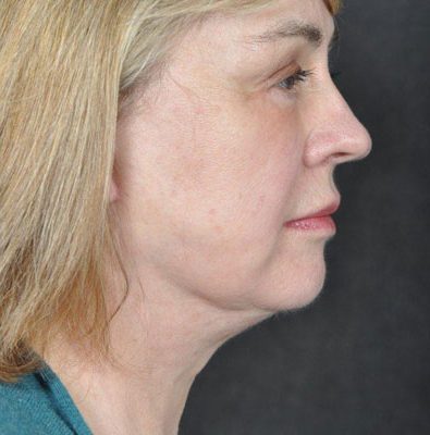 Ponytail Facelift before and after, case 27, view 3 (after)