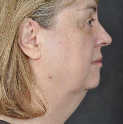 Ponytail Facelift before and after, case 27, view 3 (before)