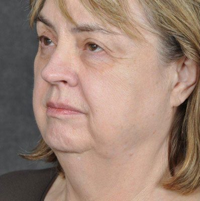 Ponytail Facelift before and after, case 27, view 4 (before)