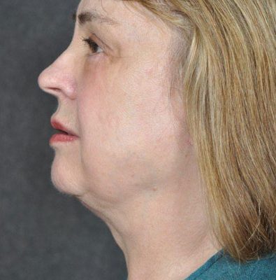 Ponytail Facelift before and after, case 27, view 5 (after)