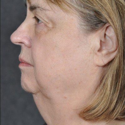 Ponytail Facelift before and after, case 27, view 5 (before)