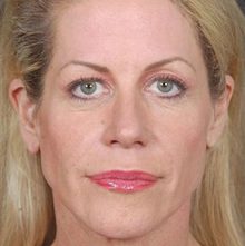 Ponytail Facelift before and after, case 28 (before)