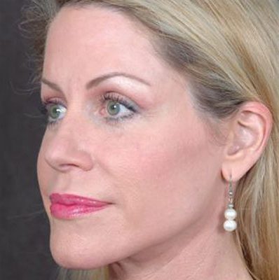 Ponytail Facelift before and after, case 28, view 4 (after)