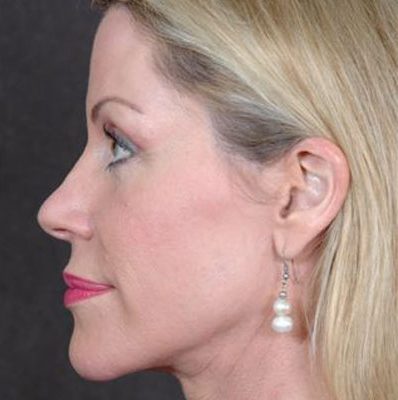 Ponytail Facelift before and after, case 28, view 5 (after)