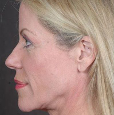 Ponytail Facelift before and after, case 28, view 5 (before)