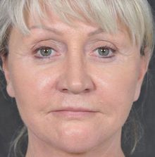 Ponytail Facelift before and after, case 29 (after)