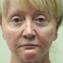 Ponytail Facelift before and after, case 29 (before)