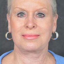 Ponytail Facelift before and after, case 30 (after)