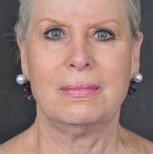 Ponytail Facelift before and after, case 30 (before)