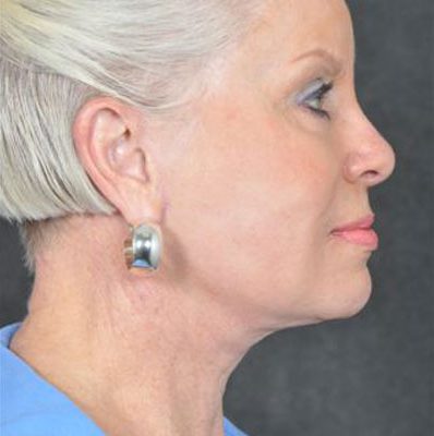 Ponytail Facelift before and after, case 30, view 3 (after)