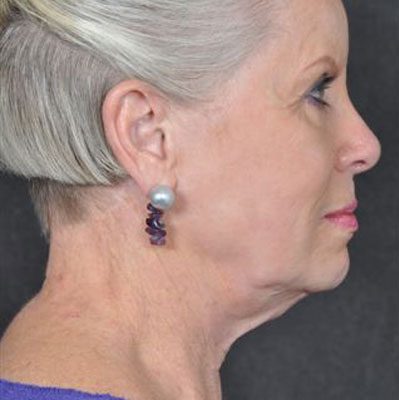 Ponytail Facelift before and after, case 30, view 3 (before)