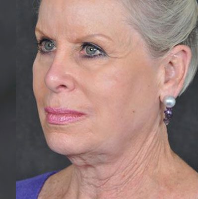 Ponytail Facelift before and after, case 30, view 4 (before)