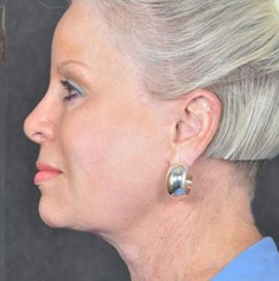 Ponytail Facelift before and after, case 30, view 5 (after)