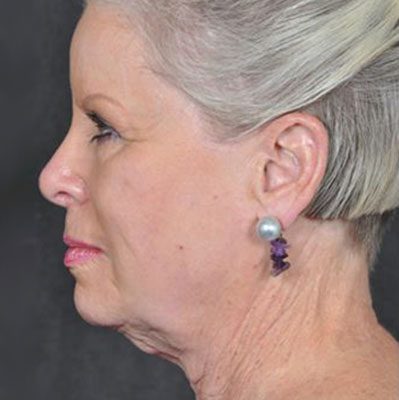 Ponytail Facelift before and after, case 30, view 5 (before)