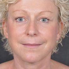 Ponytail Facelift before and after, case 31 (after)