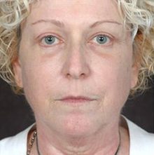 Ponytail Facelift before and after, case 31 (before)