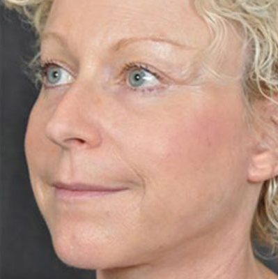 Ponytail Facelift before and after, case 31, view 3 (after)