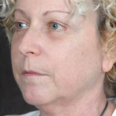 Ponytail Facelift before and after, case 31, view 3 (before)